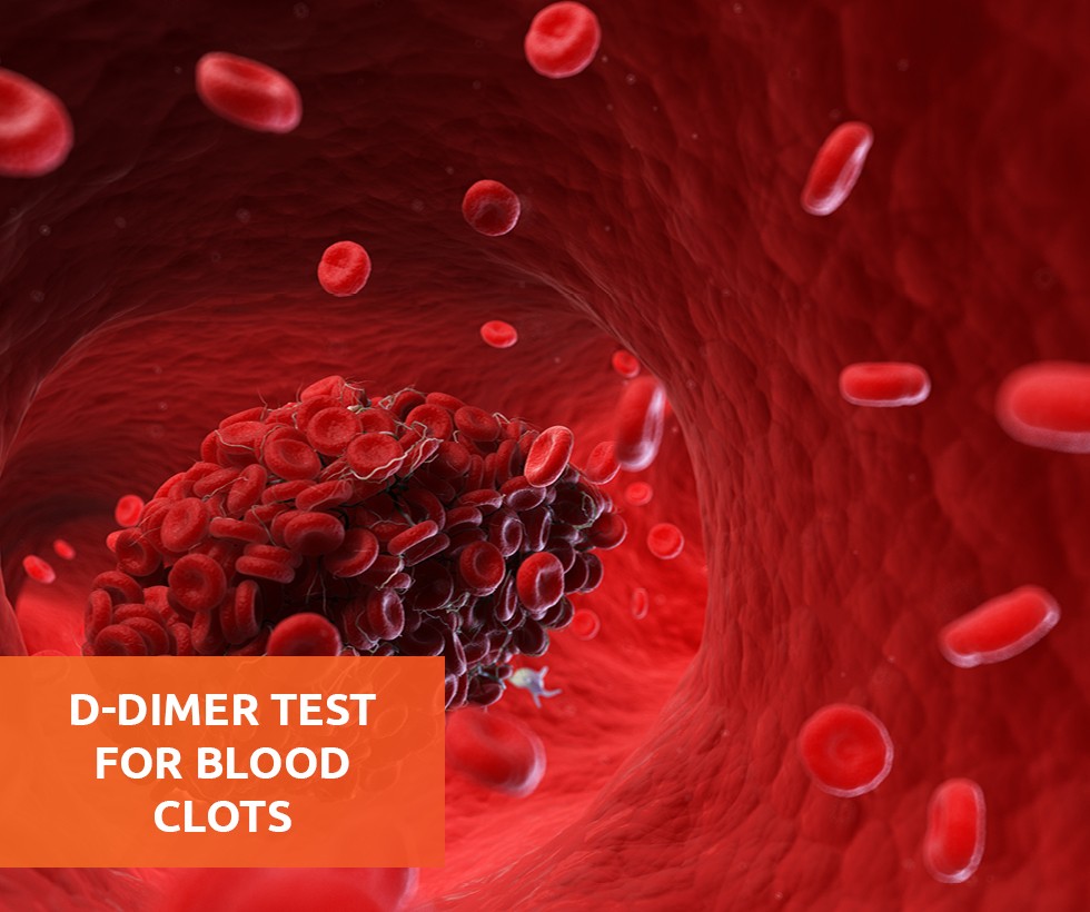 d-dimer-test-for-blood-clots-lab-online